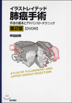 イラストレイテッド肺癌手術 手技の基本とアドバンスト.テクニック