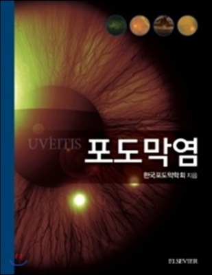 포도막염 Uveitis