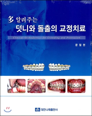 다 알려주는 덧니와 돌출의 교정치료