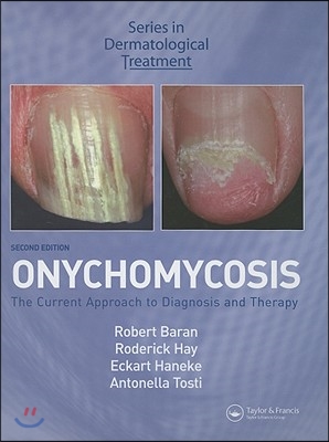 Onychomycosis