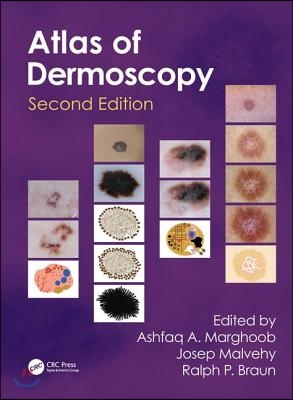 Atlas of Dermoscopy