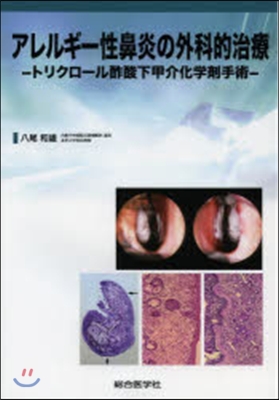 アレルギ-性鼻炎の外科的治療－トリクロ-