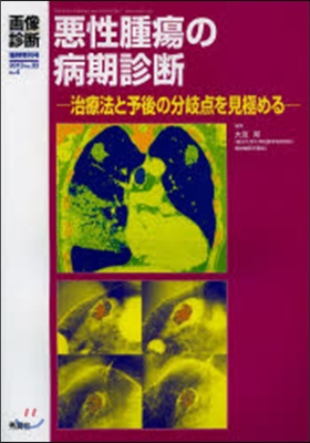 惡性腫瘍の病期診斷－治療法と予後の分岐点