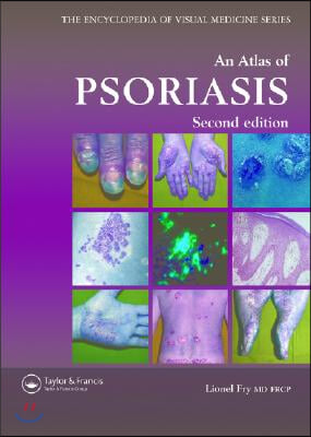 An Atlas of Psoriasis, Second Edition