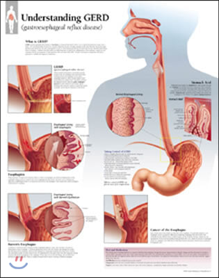 Understanding GERD (Gastroesophageal Reflux Disease) Laminated Poster