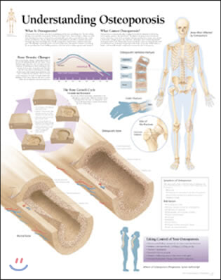 Understanding Osteoporosis Laminated Poster