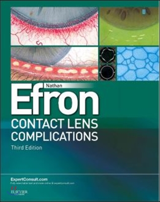 Contact Lens Complications