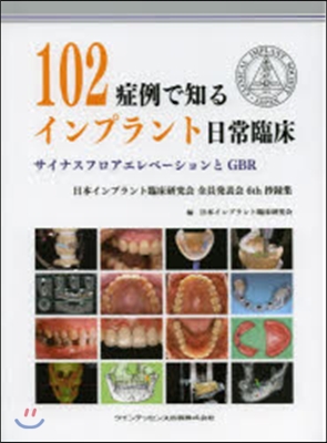 102症例で知るインプラント日常臨床