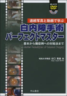 白內障手術パ-フェクトマスタ- DVD付