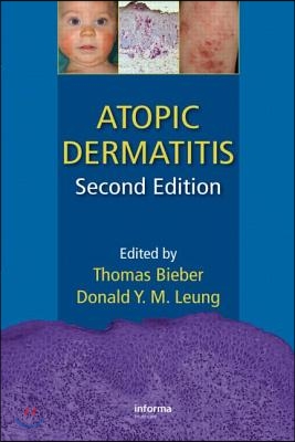 Atopic Dermatitis