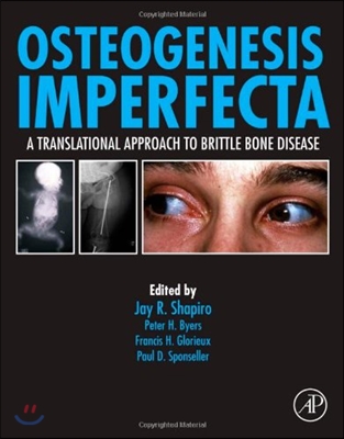 Osteogenesis Imperfecta: A Translational Approach to Brittle Bone Disease