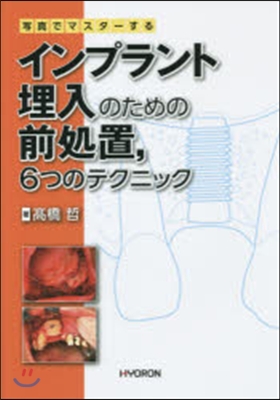 インプラント埋入のための前處置，6つのテ