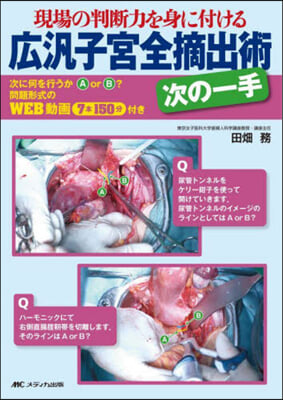 廣汎子宮全摘出術 次の一手