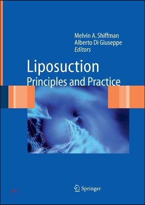 Liposuction: Principles and Practice