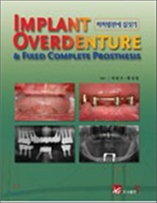 IMPLANT OVERDENTURE