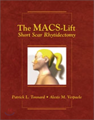 The Macs-lift Short Scar Rhytidectomy