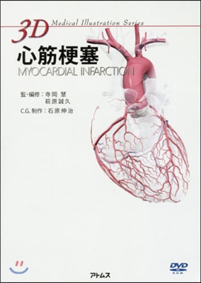 心筋梗塞MYOCARDIAL INFAR