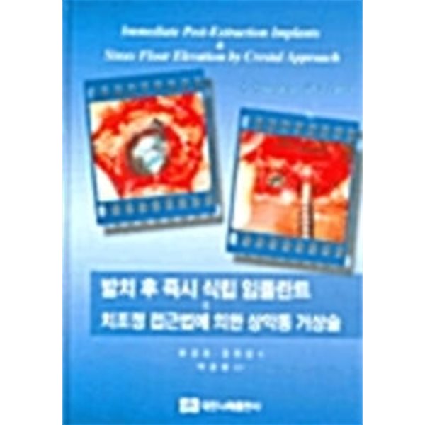 발치 후 즉시 식립 임플란트 &amp; 치조정 접근법에 의한 상악동 거상술